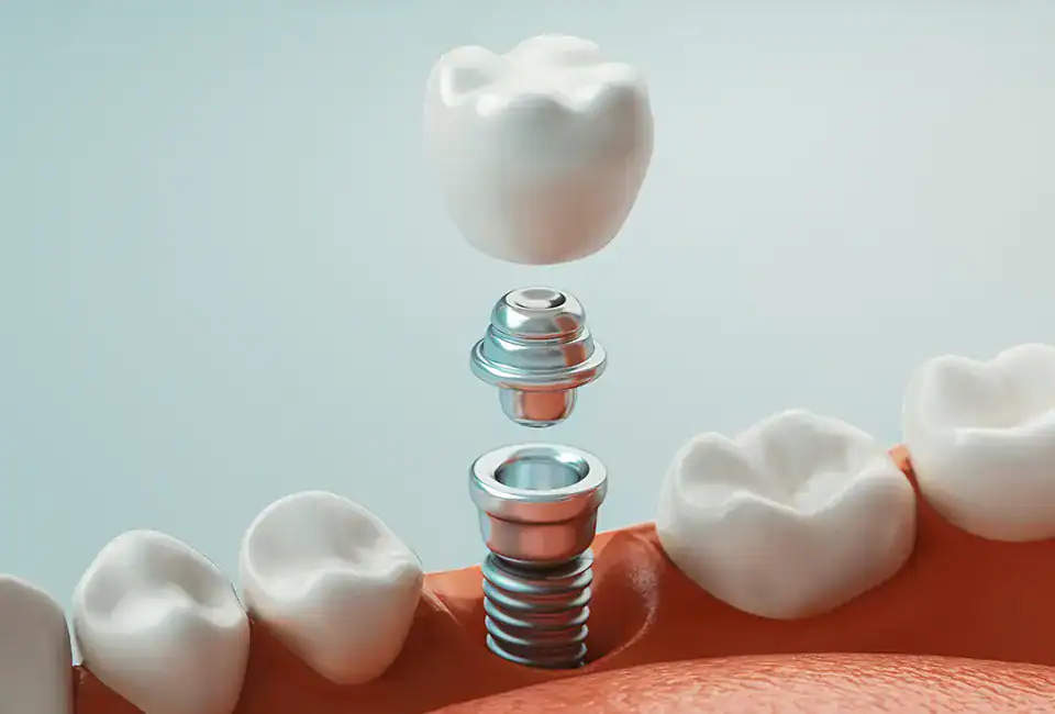 dentistry-images (4) (1) after an implant