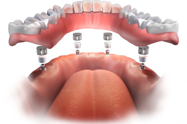 What You Should Know About All On  ® And Bone Grafting