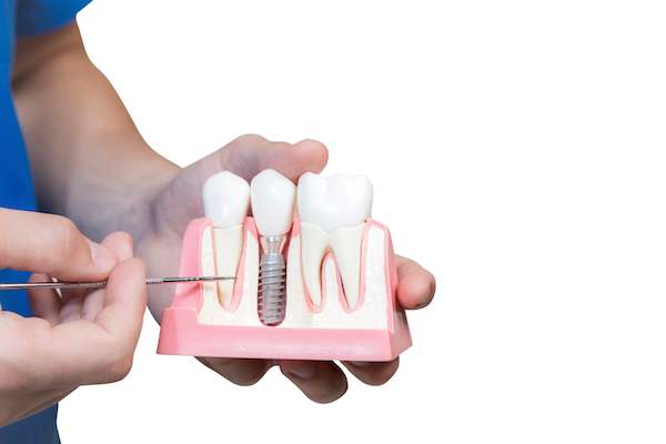 Can You Get Dental Implants if You Have Gum Disease from The Smile Spa in Agoura Hills, CA