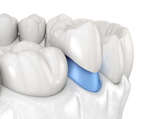 When Is A  Dental Crown Recommended?
