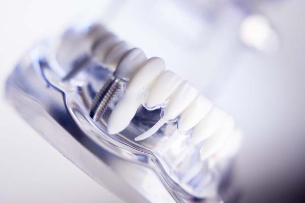 Should You Consider Getting Dental Implants?
